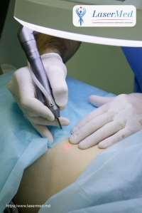 Лазерное удаление новообразований в Молдове