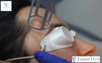 Tratament laser pentru pete pigmentare Tratament la “LaserMedChisinau” in Moldova!